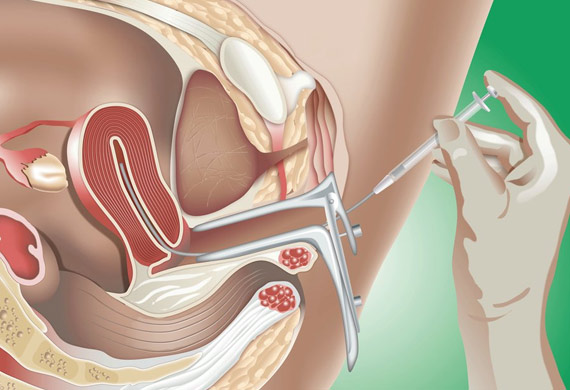 Intrauterine insemination