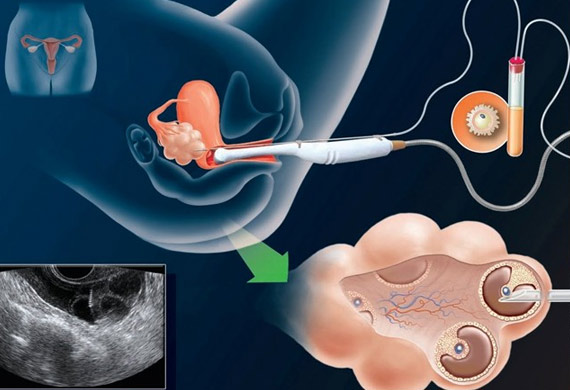 Ovarian Induction