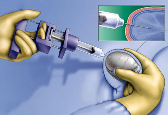 Surgical sperm retrieval