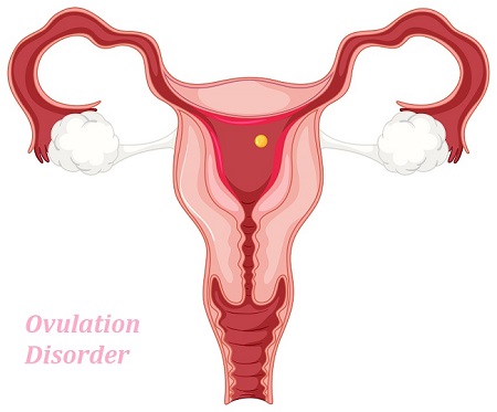 Ovulation Disorder