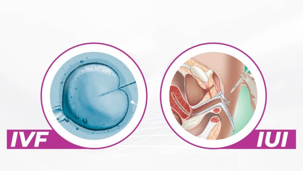 IUI and IVF