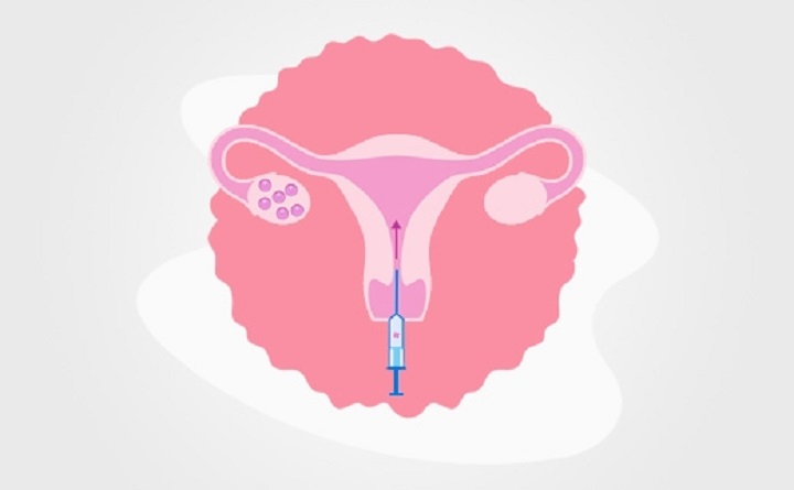 Embryo Transfer