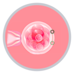 Laser-Assisted-Hatching