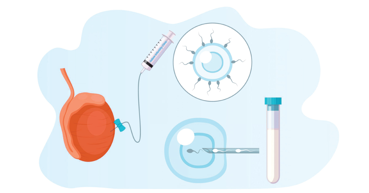 TESA Procedure
