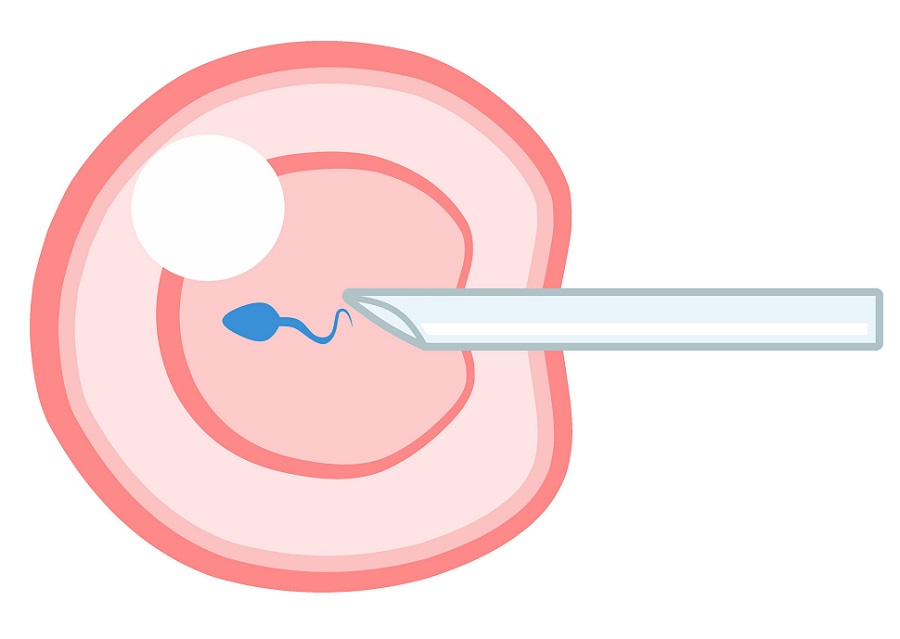 IVF Cycle