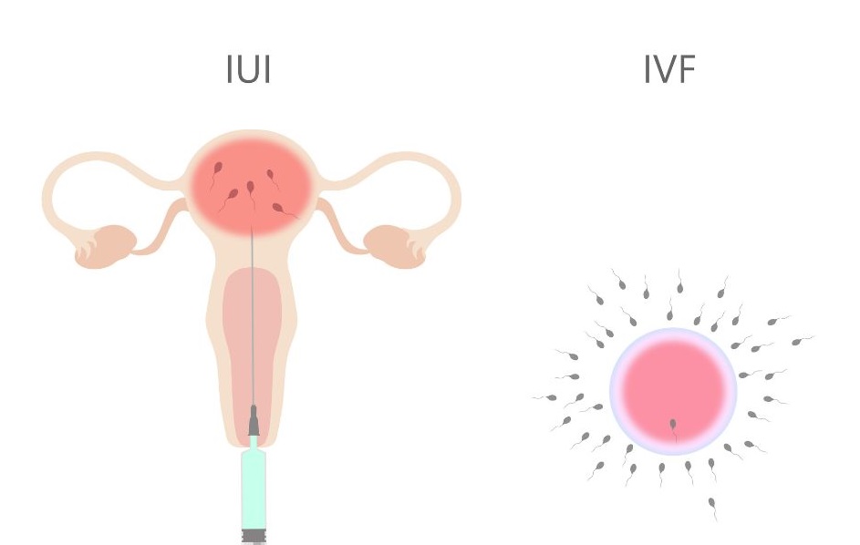 ivf iui